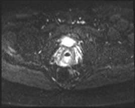 Adnexal multilocular cyst (O-RADS US 3- O-RADS MRI 3) (Radiopaedia 87426-103754 Axial DWI 20).jpg