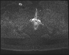 Adnexal multilocular cyst (O-RADS US 3- O-RADS MRI 3) (Radiopaedia 87426-103754 Axial DWI 58).jpg