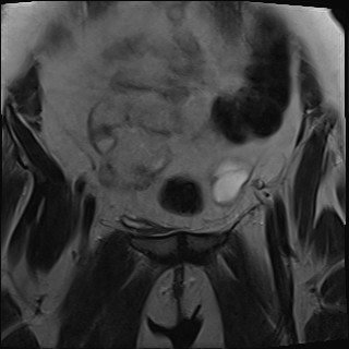 File:Adnexal multilocular cyst (O-RADS US 3- O-RADS MRI 3) (Radiopaedia 87426-103754 Coronal T2 7).jpg