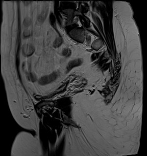 File:Adnexal multilocular cyst (O-RADS US 3- O-RADS MRI 3) (Radiopaedia 87426-103754 Sagittal T2 7).jpg