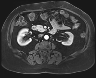 Adrenal cortical carcinoma (Radiopaedia 64017-72770 I 48).jpg