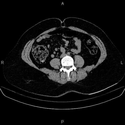 File:Adrenal cortical carcinoma (Radiopaedia 84882-100379 Axial non-contrast 55).jpg