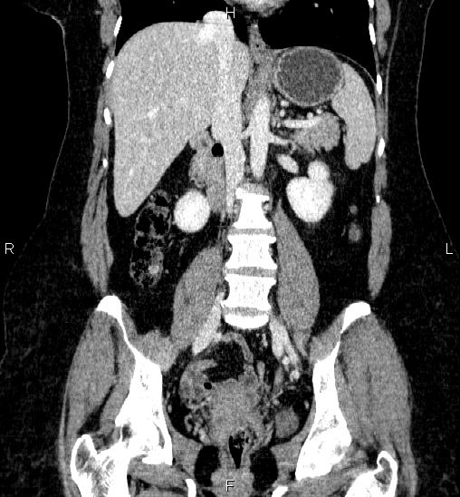Adrenal cortical carcinoma (Radiopaedia 84882-100379 Coronal C+ portal venous phase 36).jpg