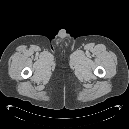 Adrenal cyst (Radiopaedia 45625-49776 Axial C+ portal venous phase 113).png