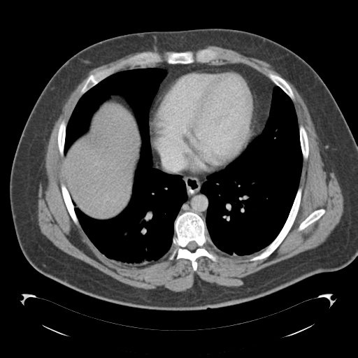 File:Adrenal cyst (Radiopaedia 45625-49776 Axial C+ portal venous phase 8).png