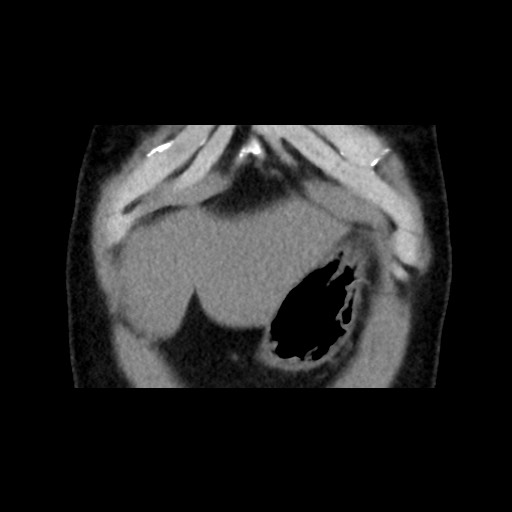 Adrenal gland trauma (Radiopaedia 81351-95079 Coronal non-contrast 15).jpg