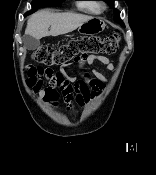 Adrenal lymphoma (Radiopaedia 73730-84529 Coronal C+ portal venous phase 14).jpg