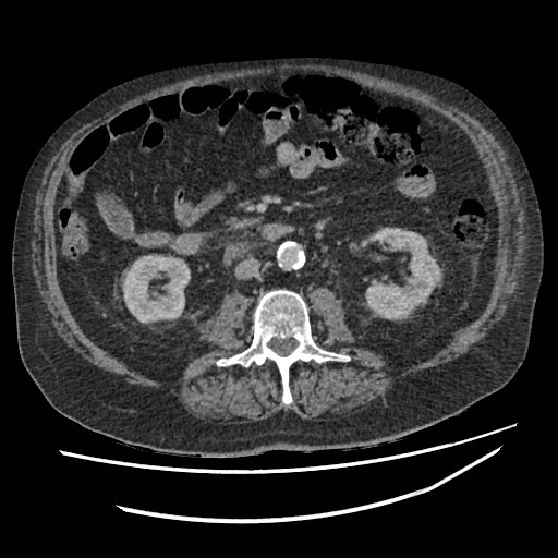 Adrenal lymphoma (Radiopaedia 84145-99415 Axial C+ portal venous phase 68).jpg