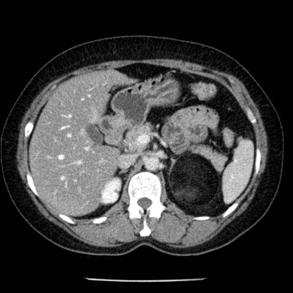 Adrenal myelolipoma (Radiopaedia 43401-46759 Axial C+ portal venous phase 27).jpg