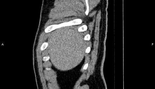 Adrenal myelolipoma (Radiopaedia 84321-99619 Sagittal non-contrast 9).jpg