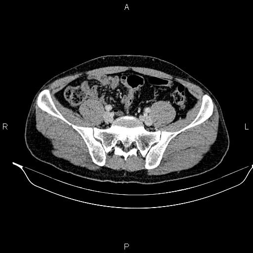 Adrenal myelolipoma (Radiopaedia 87794-104246 Axial renal cortical phase 80).jpg