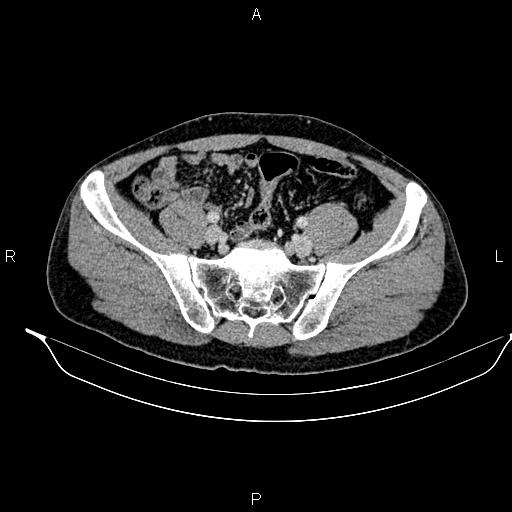 Adrenal myelolipoma (Radiopaedia 87794-104246 Axial renal cortical phase 82).jpg