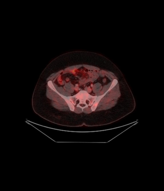 Adrenocortical carcinoma (Radiopaedia 80134-93440 ِAxial 220).jpg