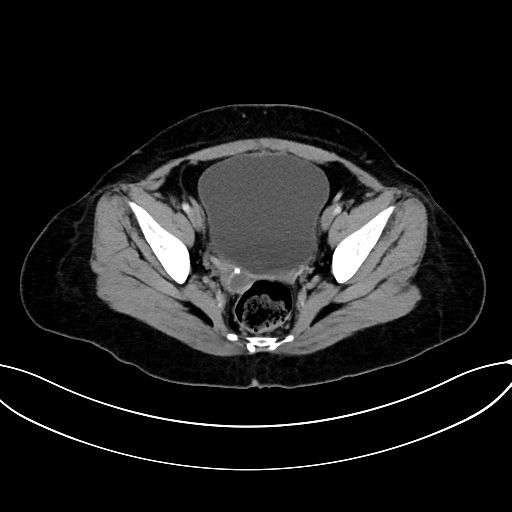 Adrenocortical carcinoma (Radiopaedia 87281-103569 Axial C+ portal venous phase 75).jpg
