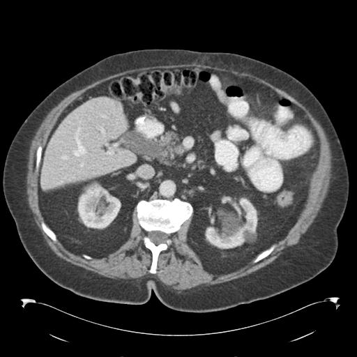 Adult ileal intussusception with secondary obstruction (Radiopaedia 30395-31051 Axial C+ portal venous phase 28).jpg