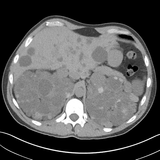 Adult polycystic kidney disease (Radiopaedia 47866-52626 Axial non-contrast 18).png