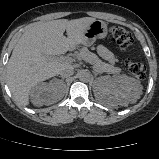 Adult polycystic kidney disease (Radiopaedia 59075-66368 Axial non-contrast 14).jpg