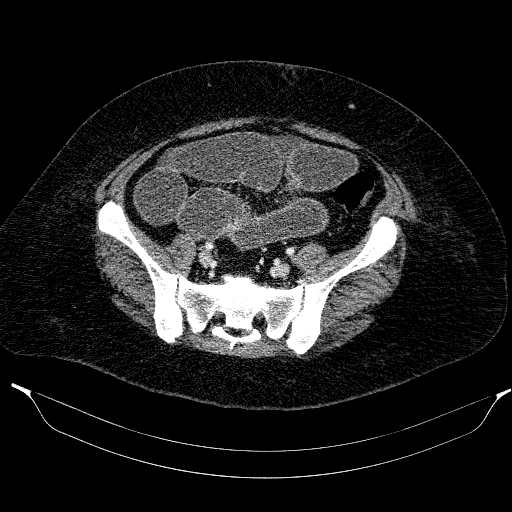 Afferent loop syndrome - secondary to incarcerated trocar site hernia (Radiopaedia 82959-97305 Axial C+ portal venous phase 177).jpg