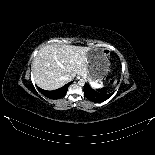 Afferent loop syndrome - secondary to incarcerated trocar site hernia (Radiopaedia 82959-97305 Axial C+ portal venous phase 39).jpg