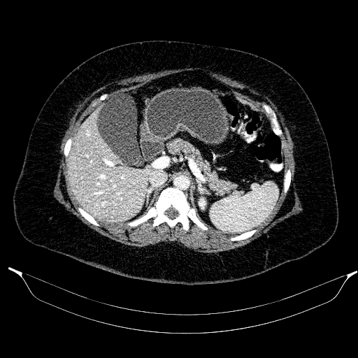 Afferent loop syndrome - secondary to incarcerated trocar site hernia (Radiopaedia 82959-97305 Axial C+ portal venous phase 70).jpg