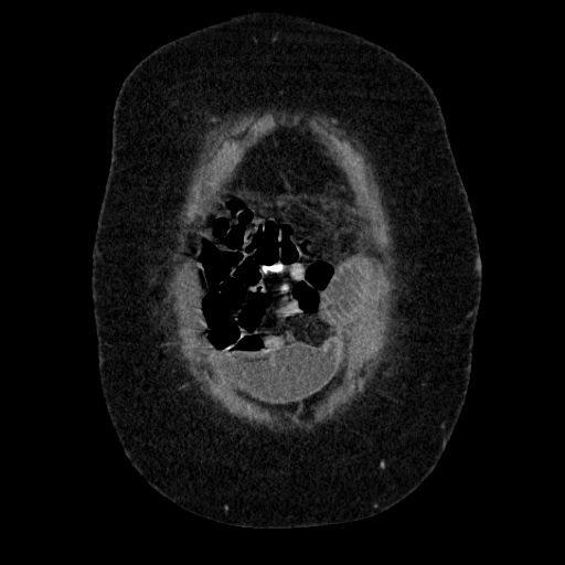 File:Afferent loop syndrome - secondary to incarcerated trocar site hernia (Radiopaedia 82959-97305 Coronal C+ portal venous phase 30).jpg