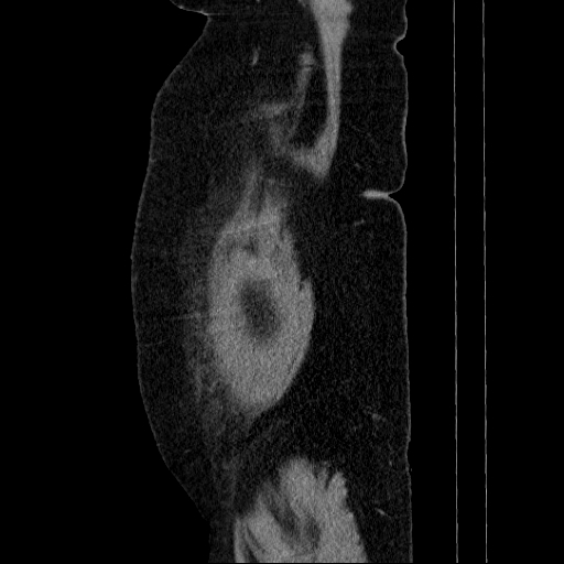 Afferent loop syndrome - secondary to incarcerated trocar site hernia (Radiopaedia 82959-97305 Sagittal C+ portal venous phase 148).jpg