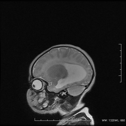 File:Agenesis of the corpus callosum (Radiopaedia 16190-16010 Sagittal T2 4).png
