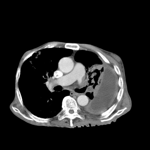 Aggressive lung cancer with cardiac metastases, pulmonary artery tumor thrombus, and Budd-Chiari (Radiopaedia 60320-67981 A 27).jpg