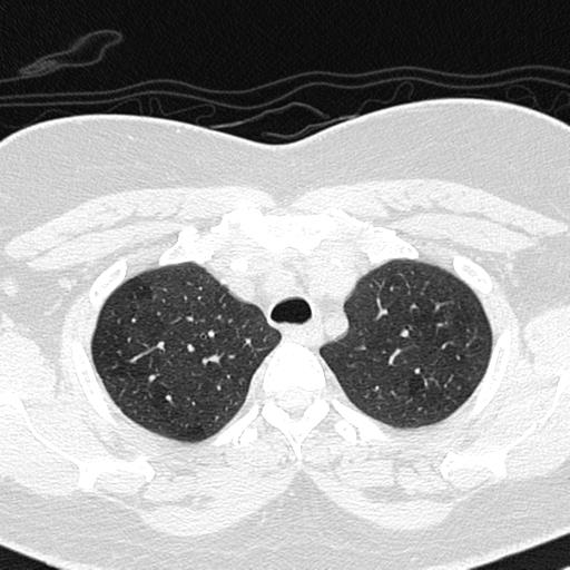 Air trapping in small airway disease (Radiopaedia 61685-69694 Axial lung window 33).jpg