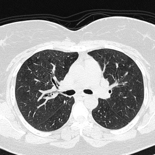 Air trapping in small airway disease (Radiopaedia 61685-69694 Axial lung window 69).jpg