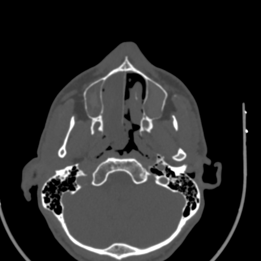 Allergic fungal sinusitis (Radiopaedia 88725-105456 Axial bone window 11).jpg