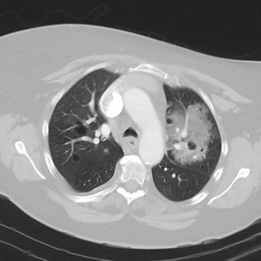 Alveolar hemorrhage and possible lymphocytic interstitial pneumonitis in systemic lupus erythematosus (Radiopaedia 28582-28839 Axial lung window 17).jpg