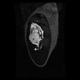 Alveolar soft part sarcoma (Radiopaedia 64501-73678 D 121).jpg