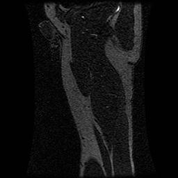 Alveolar soft part sarcoma (Radiopaedia 64501-73678 D 30).jpg