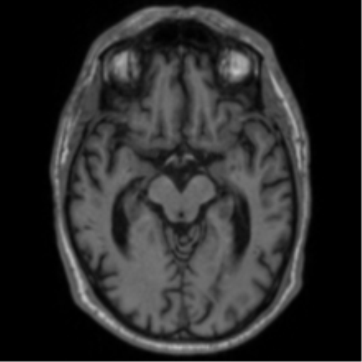Alzheimer's disease- with Gerstmann syndrome and dressing apraxia (Radiopaedia 54882-61150 Axial T1 31).png
