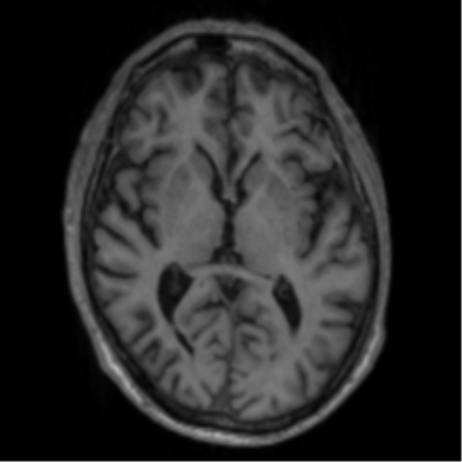 Alzheimer's disease- with apraxia (Radiopaedia 54763-61011 Axial T1 38).png