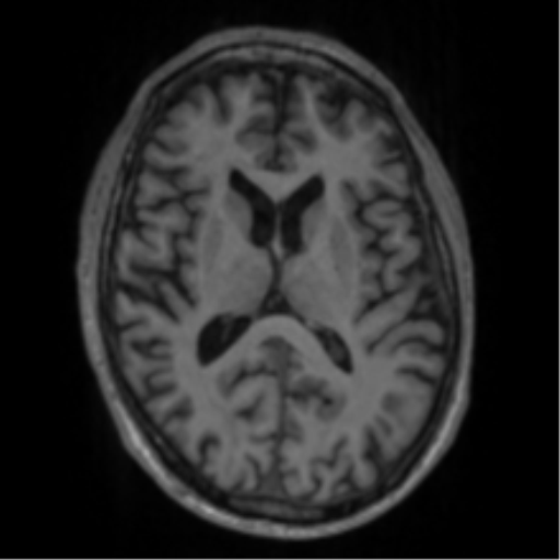 Alzheimer's disease- with apraxia (Radiopaedia 54763-61011 Axial T1 41).png