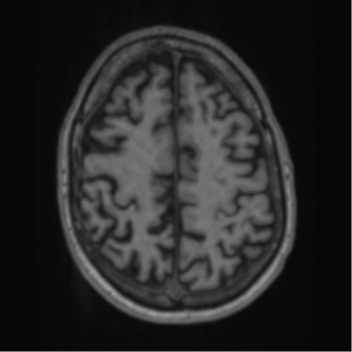 Alzheimer's disease- with apraxia (Radiopaedia 54763-61011 Axial T1 56).png