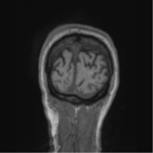 File:Alzheimer's disease- with apraxia (Radiopaedia 54763-61011 Coronal T1 12).png