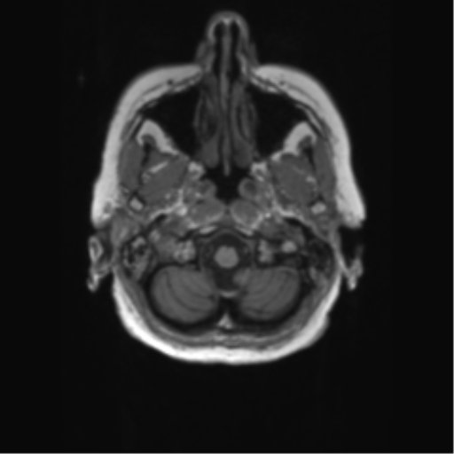File:Alzheimer's disease (Radiopaedia 42658-45802 Axial T1 136).png