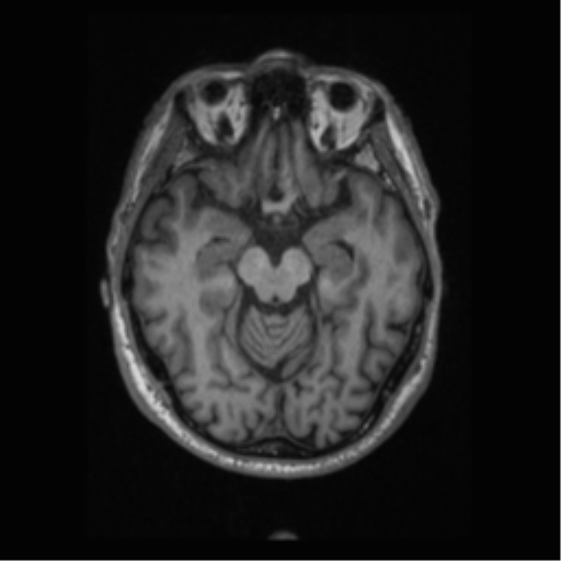 File:Alzheimer disease - probable (Radiopaedia 35334-36837 Axial T1 32).png