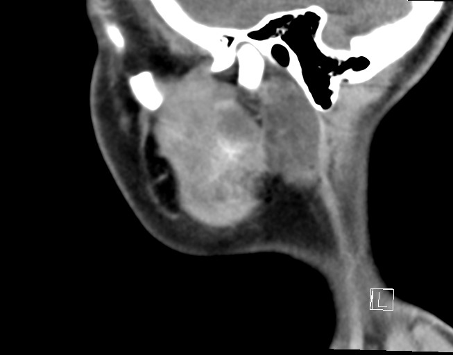 File:Ameloblastoma (Radiopaedia 26645-26793 Sagittal C+ delayed 3).jpg
