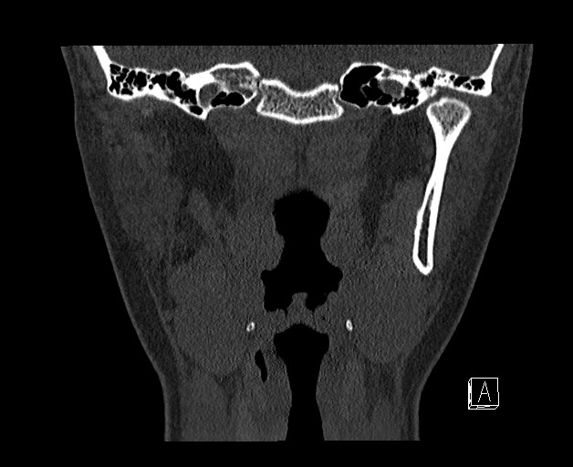 File:Ameloblastoma (Radiopaedia 26645-26793 bone window 22).jpg