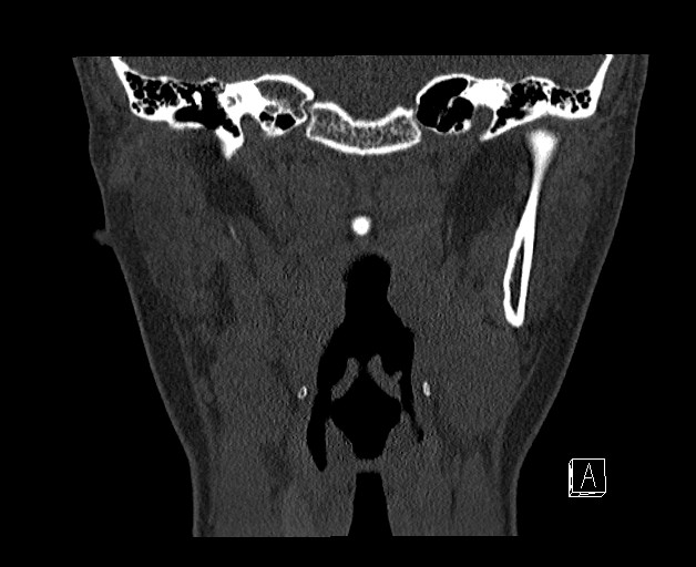File:Ameloblastoma (Radiopaedia 26645-26793 bone window 23).jpg