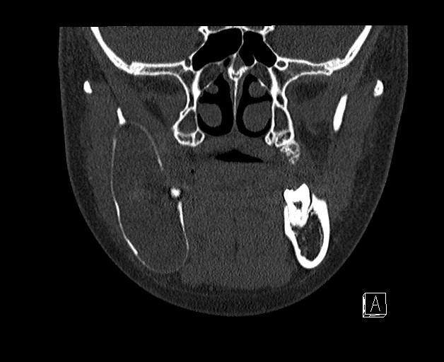 File:Ameloblastoma (Radiopaedia 26645-26793 bone window 9).jpg