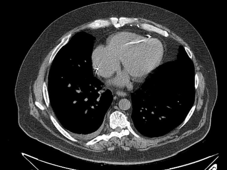 Amiodarone lung (Radiopaedia 62514-70769 Axial non-contrast 61).jpg