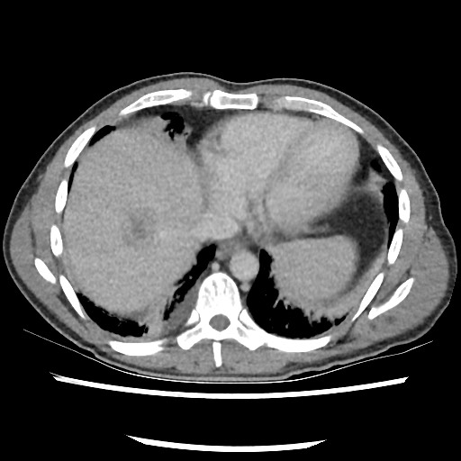 Amoebic liver abscesses (Radiopaedia 55536-62010 A 10).jpg