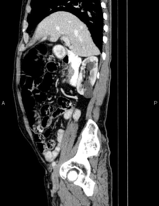 Ampullary adenocarcinoma (Radiopaedia 86093-102032 D 29).jpg