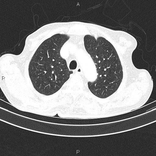 Ampullary adenocarcinoma (Radiopaedia 86093-102033 Axial lung window 22).jpg