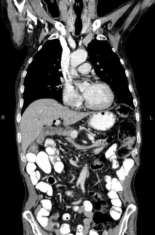 Ampullary adenocarcinoma (Radiopaedia 86093-102033 D 23).jpg
